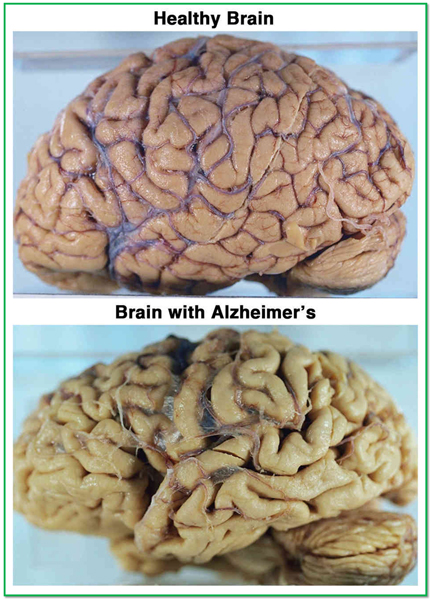 Alzheimer's Disease