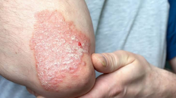  Psoriatic Arthritis