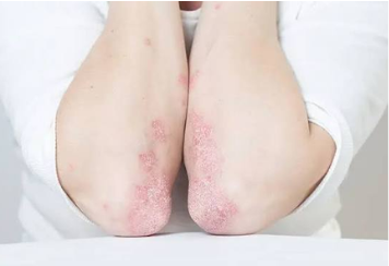 Upadoz / Upadacitinib and Psoriatic Arthritis
