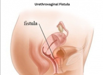 Urethrovaginal Fistula