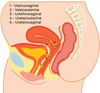 Urethrovaginal Fistula
