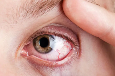  Diabetic Retinopathy
